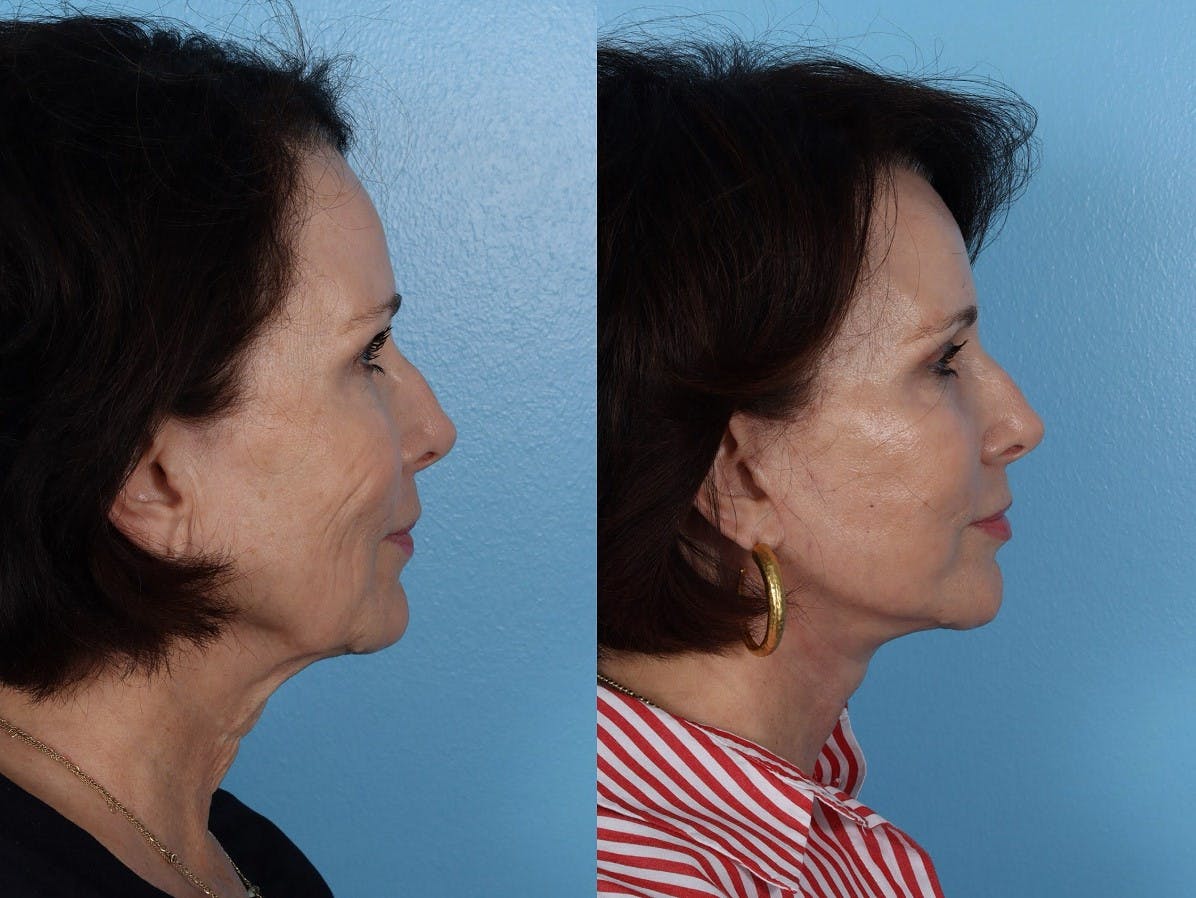 Facelift Before & After Gallery - Patient 474062 - Image 3