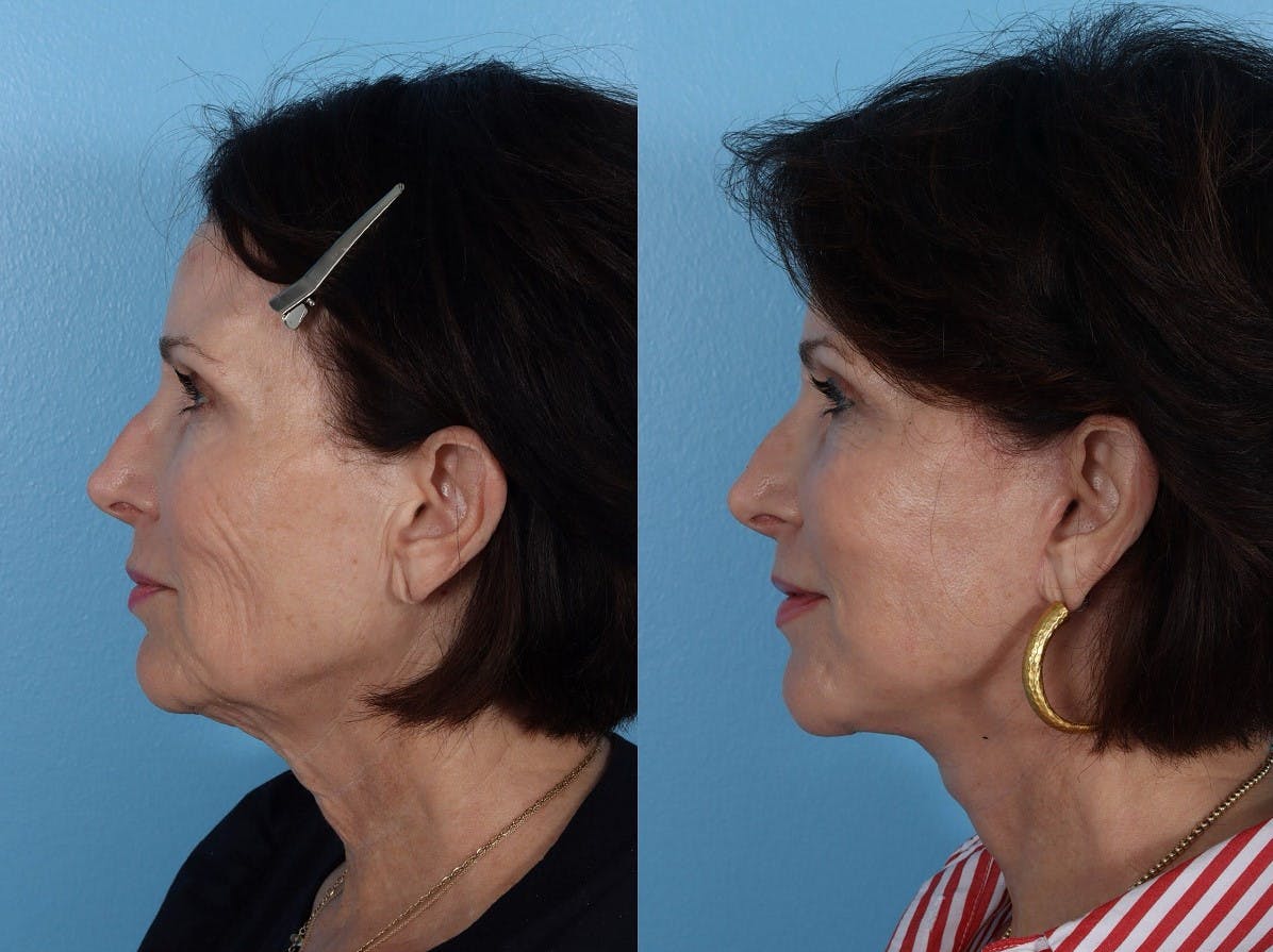 Facelift Before & After Gallery - Patient 474062 - Image 5