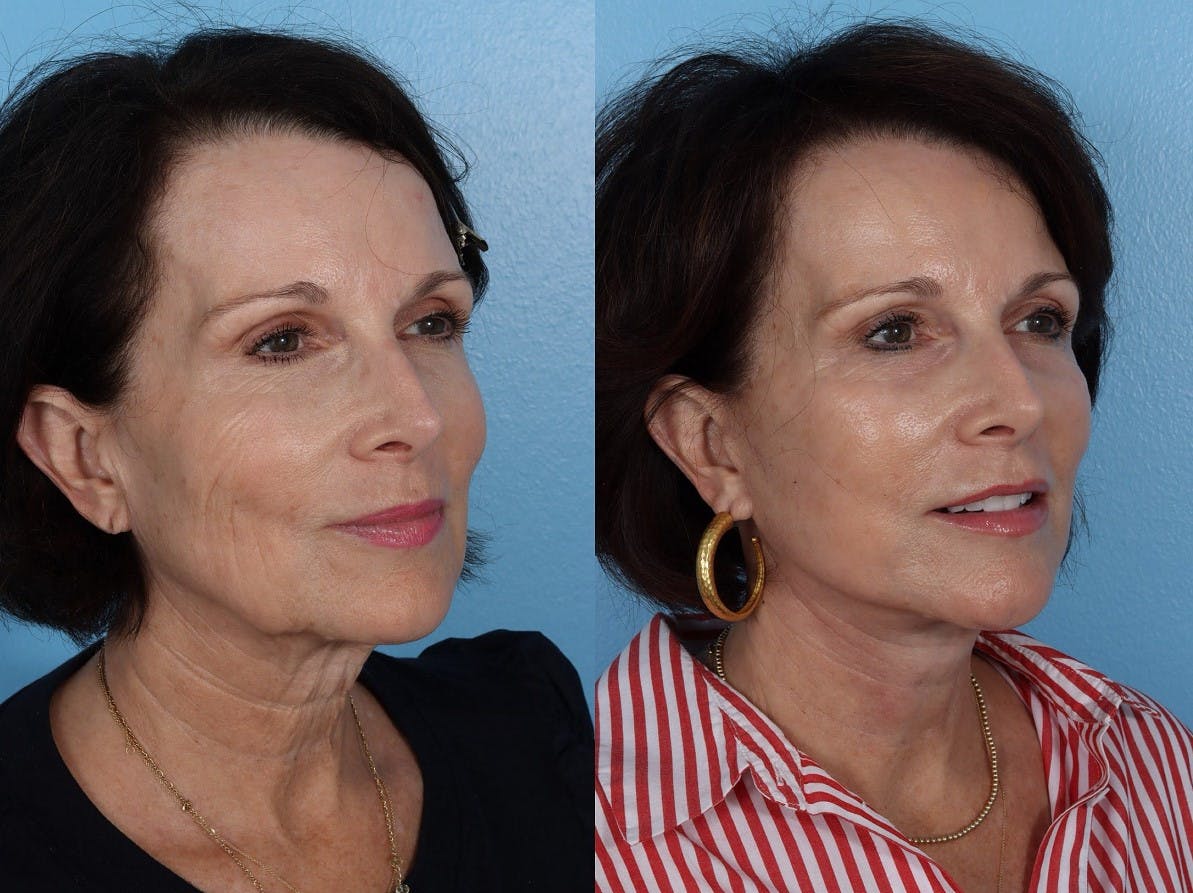 Facelift Before & After Gallery - Patient 474062 - Image 2