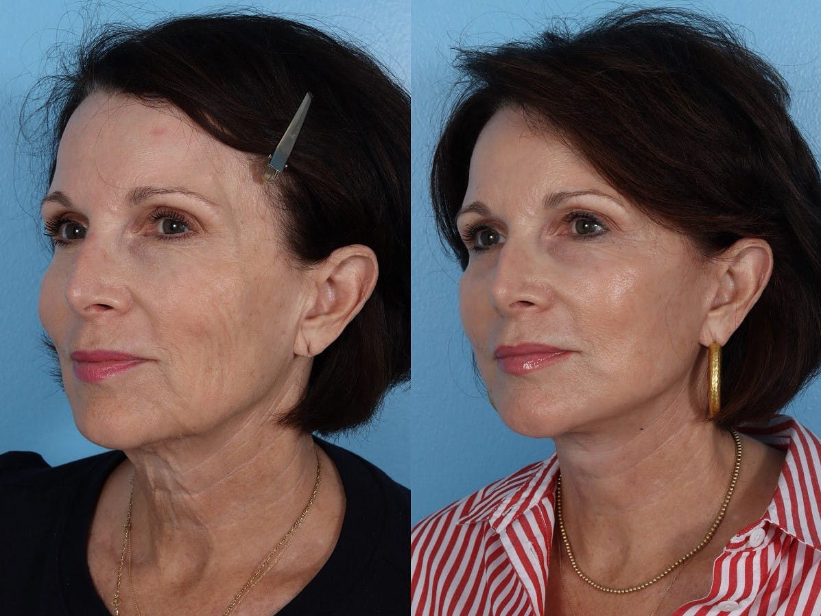 Facelift Before & After Gallery - Patient 474062 - Image 4
