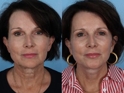 Facelift Before & After Gallery - Patient 474062 - Image 1