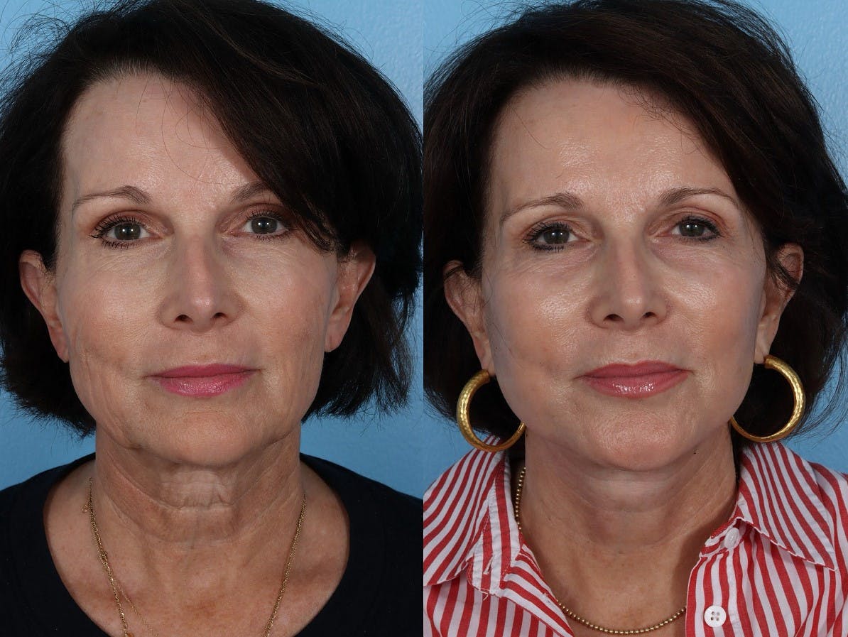 Facelift Before & After Gallery - Patient 474062 - Image 1