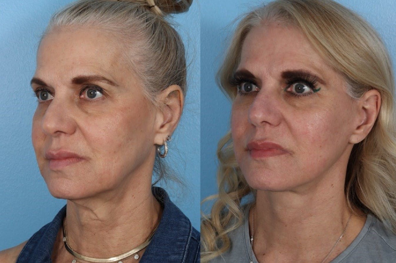 Limited Incision Facelift Before & After Gallery - Patient 145858 - Image 4