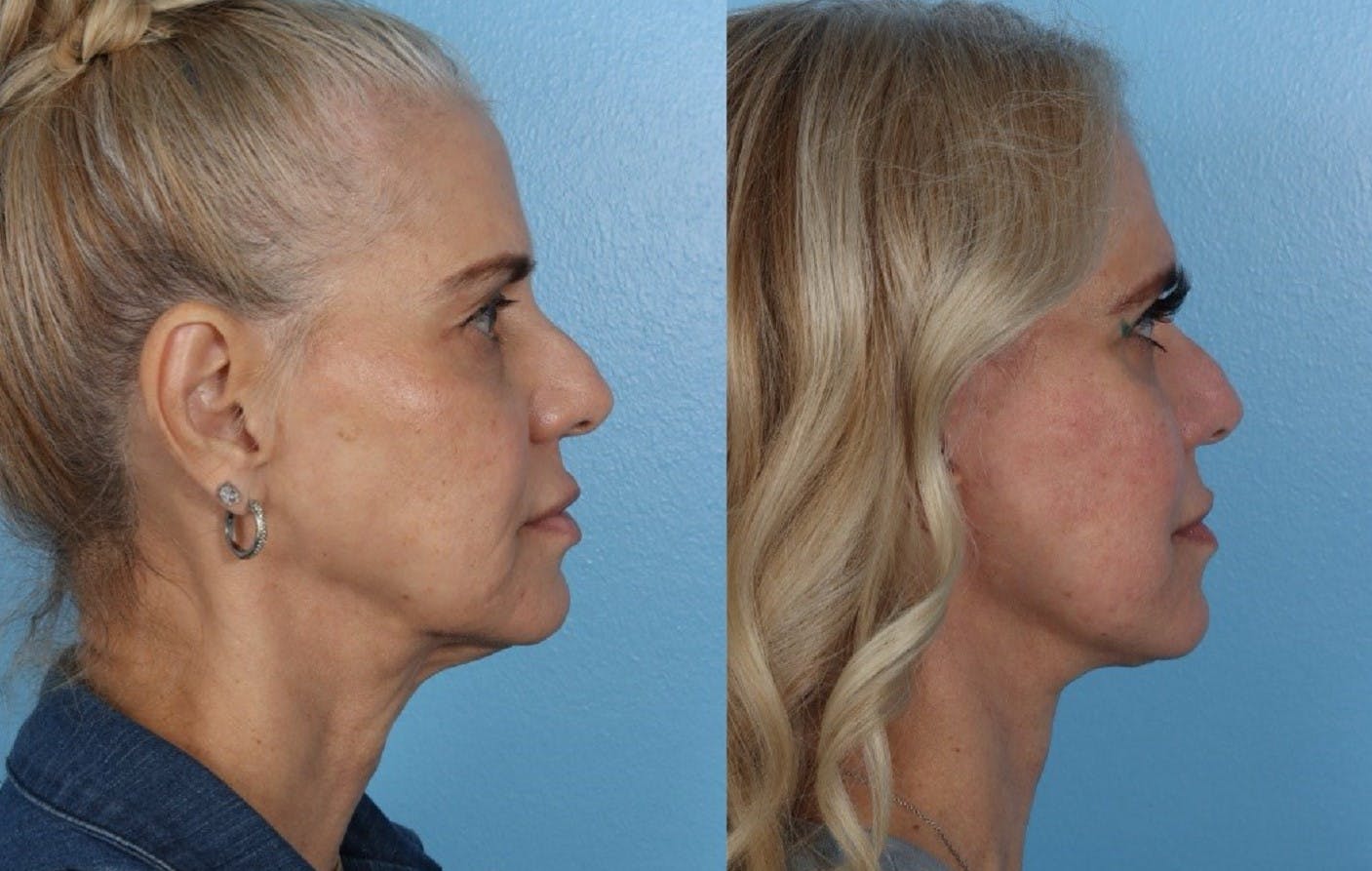 Limited Incision Facelift Before & After Gallery - Patient 145858 - Image 1