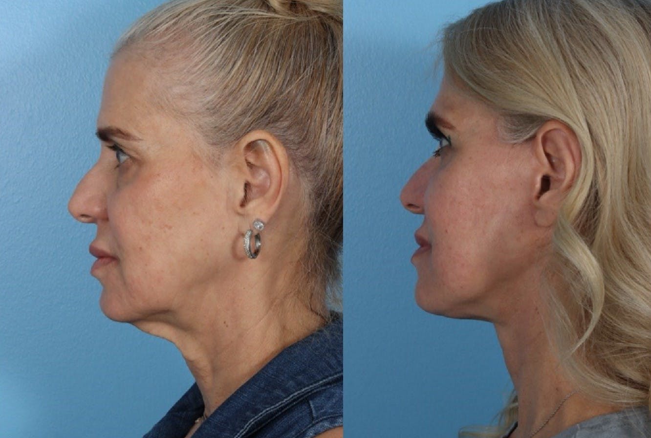 Limited Incision Facelift Before & After Gallery - Patient 145858 - Image 3