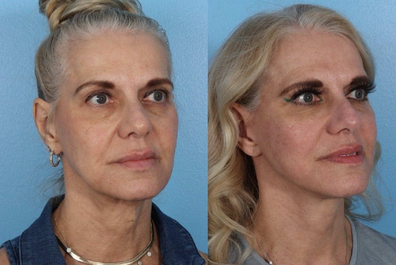 Limited Incision Facelift Before & After Gallery - Patient 145858 - Image 2