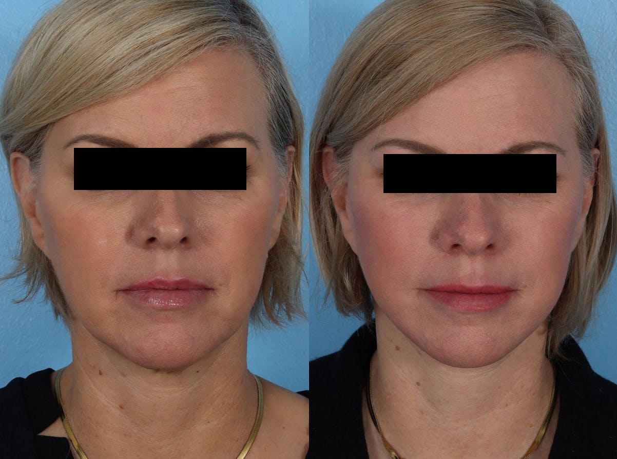 Limited Incision Facelift Before & After Gallery - Patient 381945 - Image 1