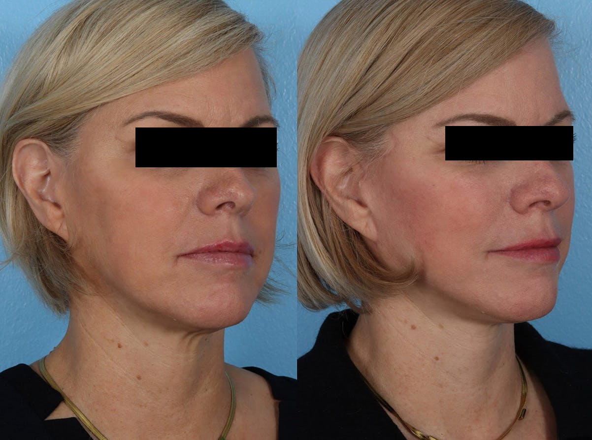 Limited Incision Facelift Before & After Gallery - Patient 381945 - Image 2