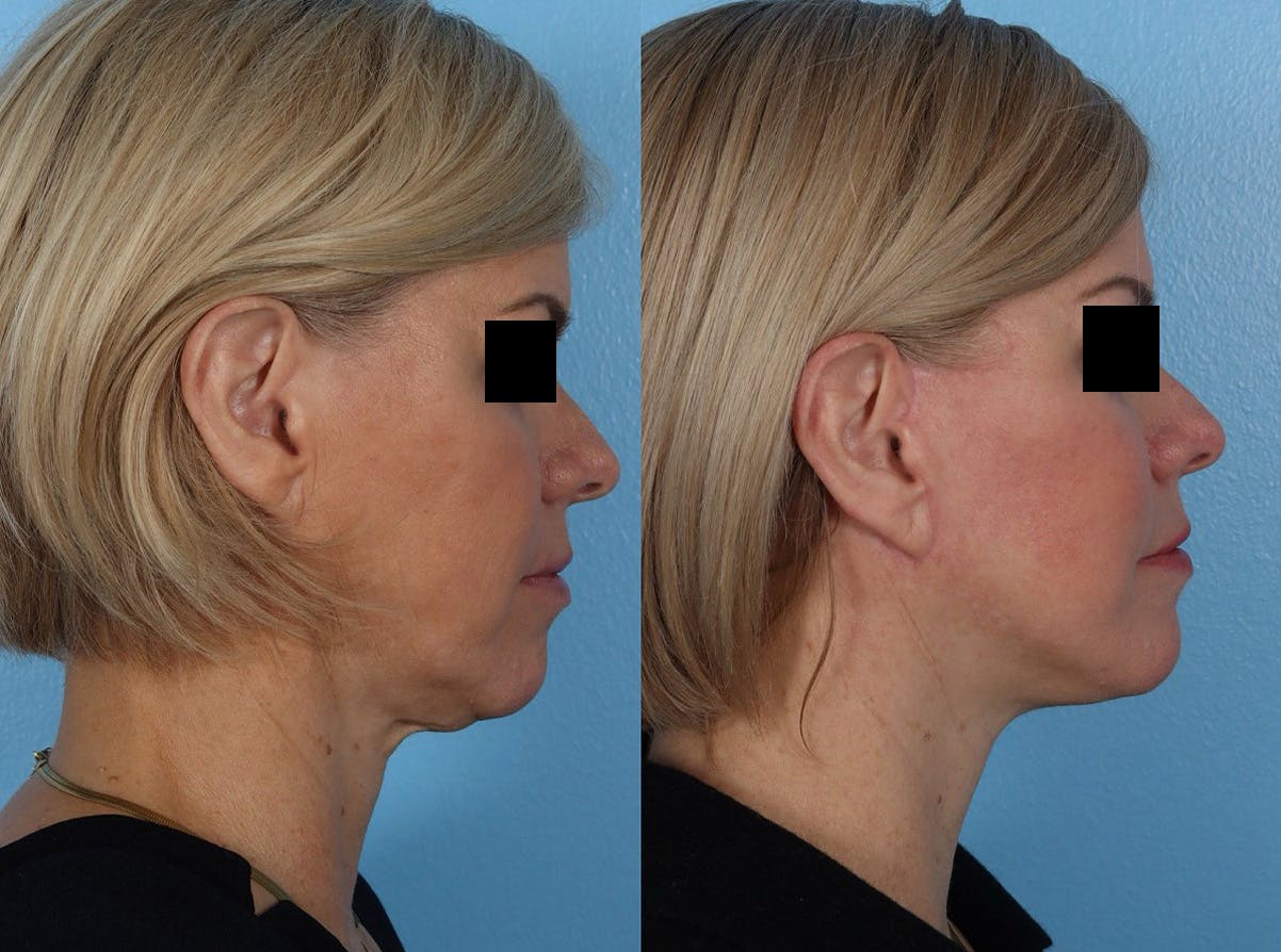 Limited Incision Facelift Before & After Gallery - Patient 381945 - Image 3