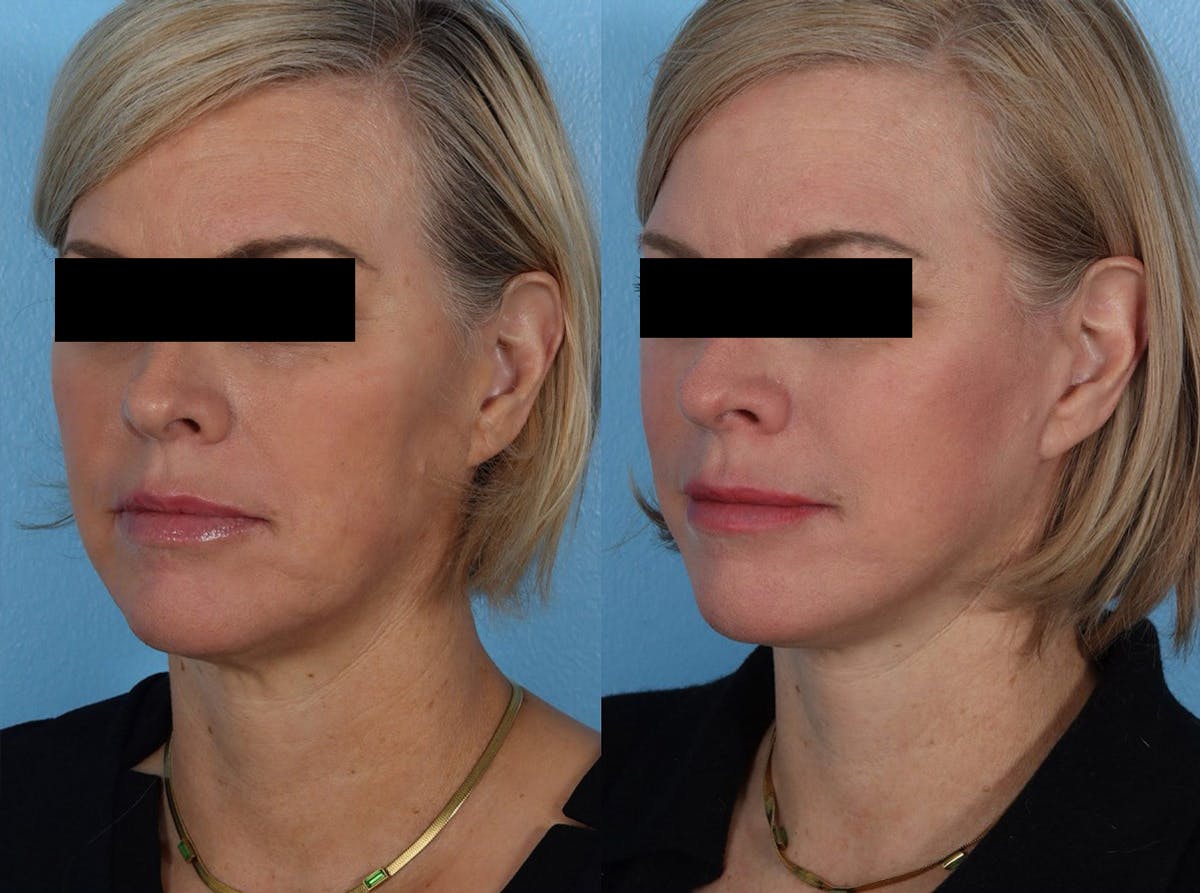 Limited Incision Facelift Before & After Gallery - Patient 381945 - Image 4