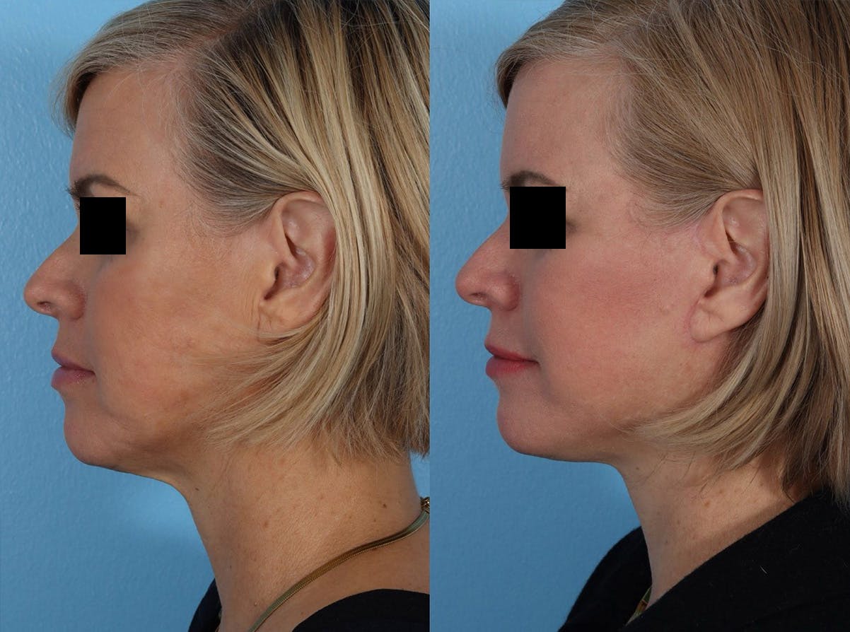 Limited Incision Facelift Before & After Gallery - Patient 381945 - Image 5