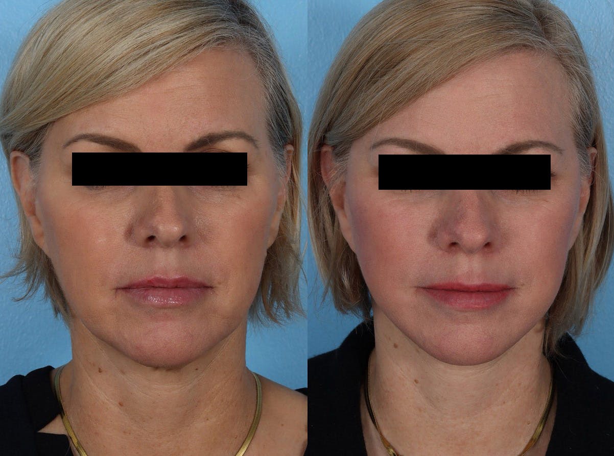 Skin Cancer Before & After Gallery - Patient 159606 - Image 1