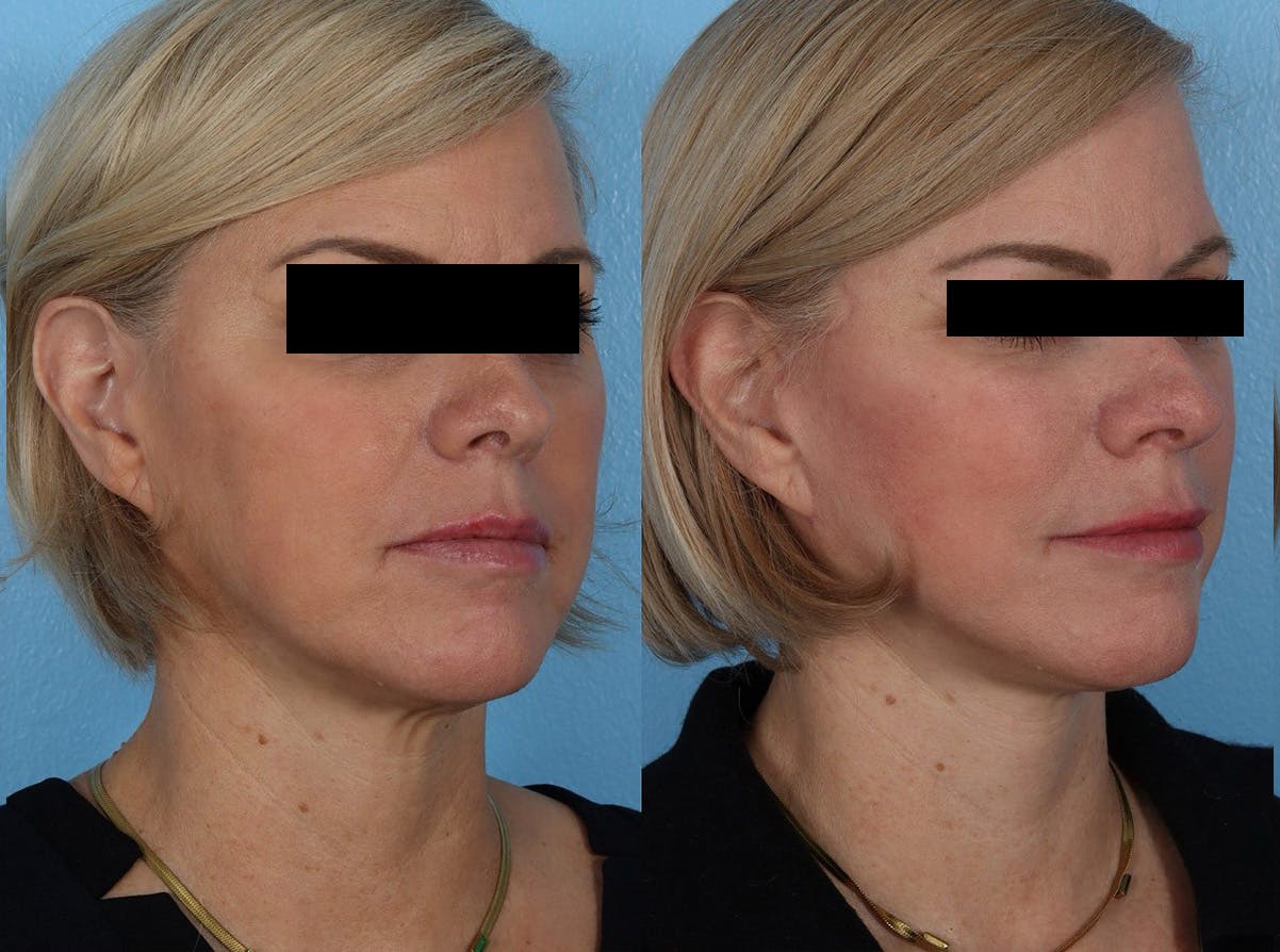 Skin Cancer Before & After Gallery - Patient 159606 - Image 2