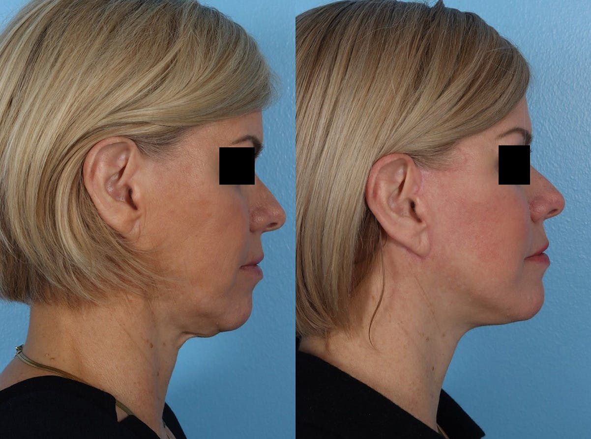 Skin Cancer Before & After Gallery - Patient 159606 - Image 3