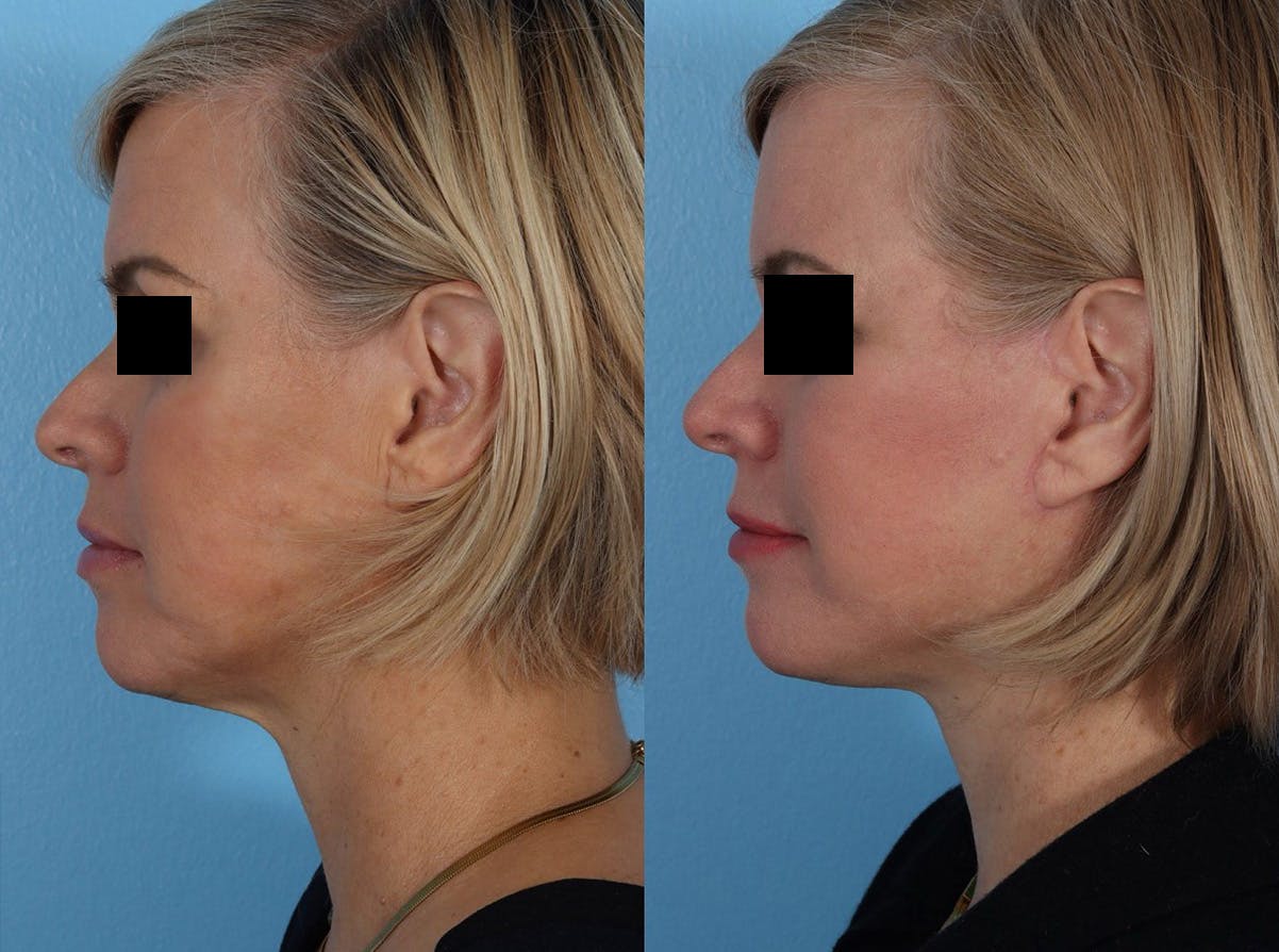 Skin Cancer Before & After Gallery - Patient 159606 - Image 5