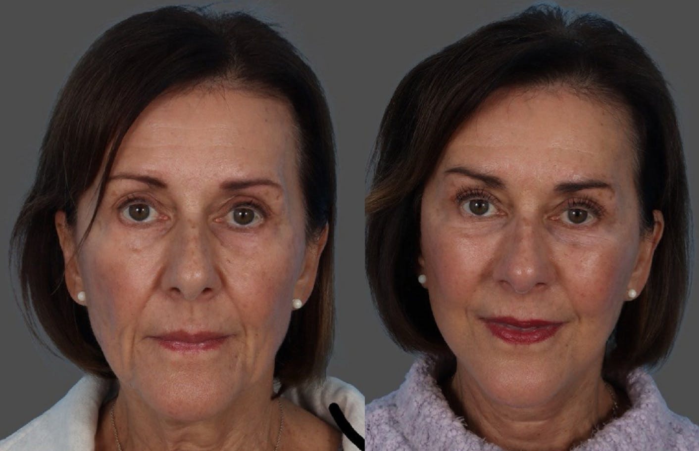 Facelift Before & After Gallery - Patient 191650 - Image 1