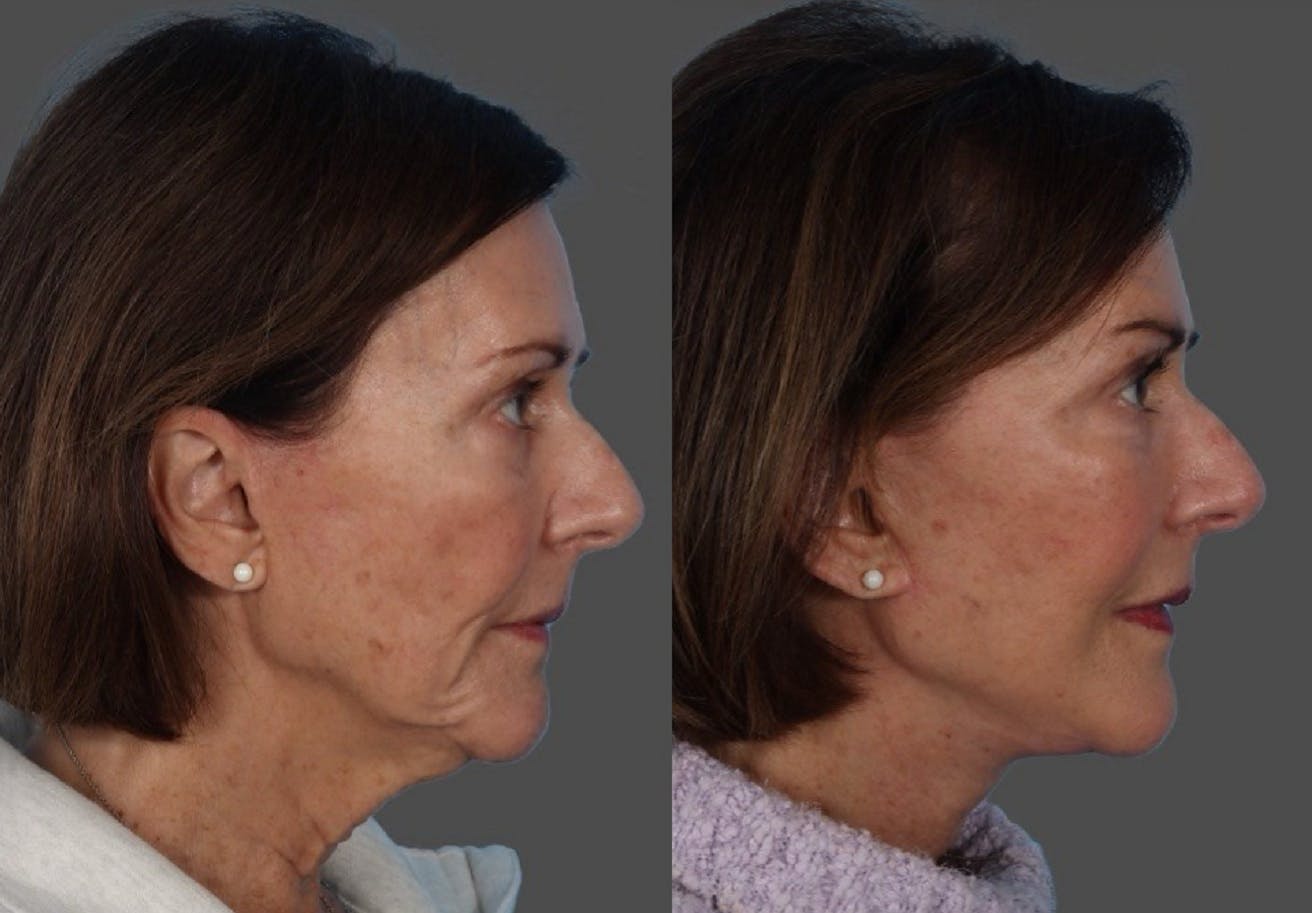 Facelift Before & After Gallery - Patient 191650 - Image 3