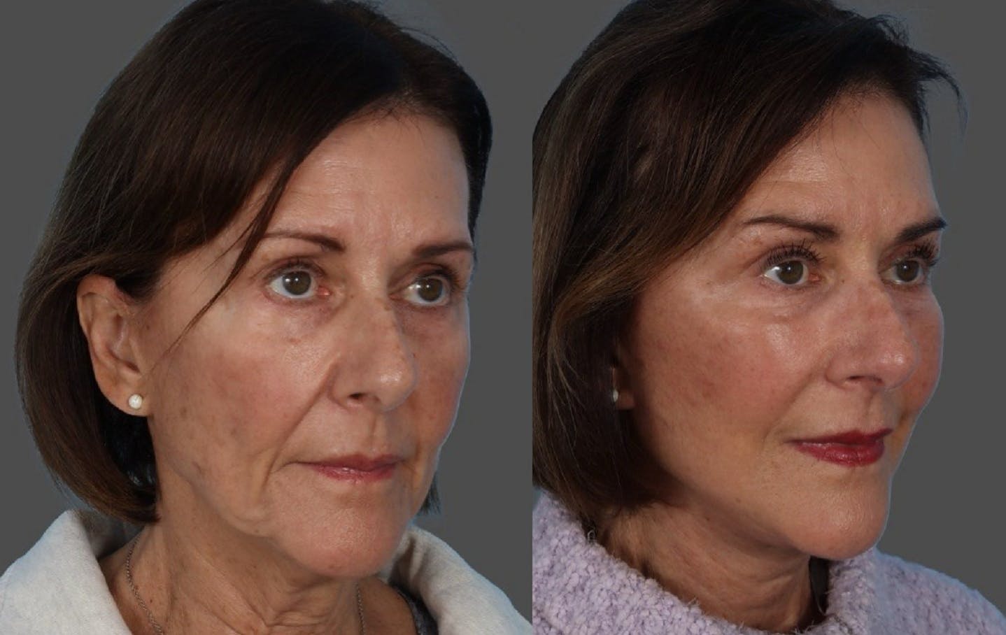 Facelift Before & After Gallery - Patient 191650 - Image 2