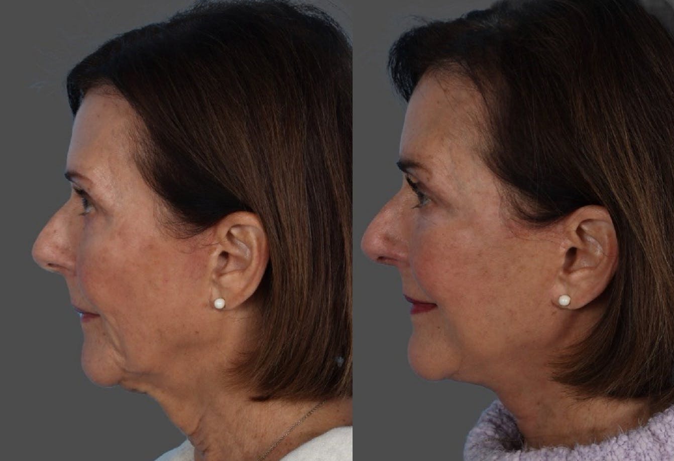 Facelift Before & After Gallery - Patient 191650 - Image 5