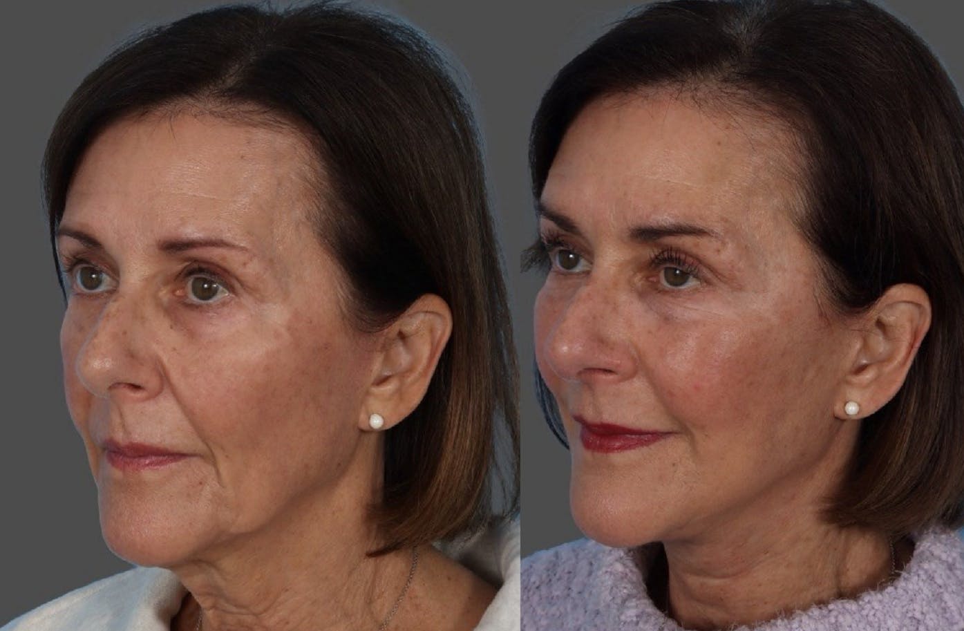 Facelift Before & After Gallery - Patient 191650 - Image 4