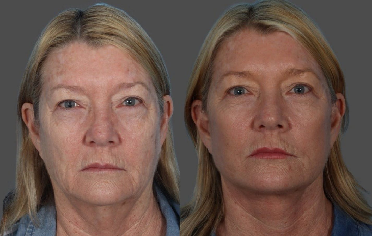 Facelift Before & After Gallery - Patient 855207 - Image 1