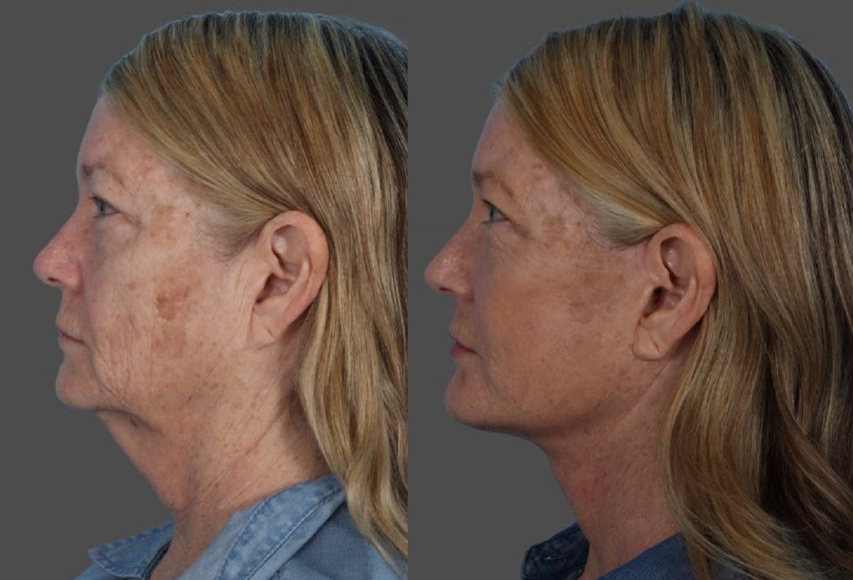 Facelift Before & After Gallery - Patient 855207 - Image 5