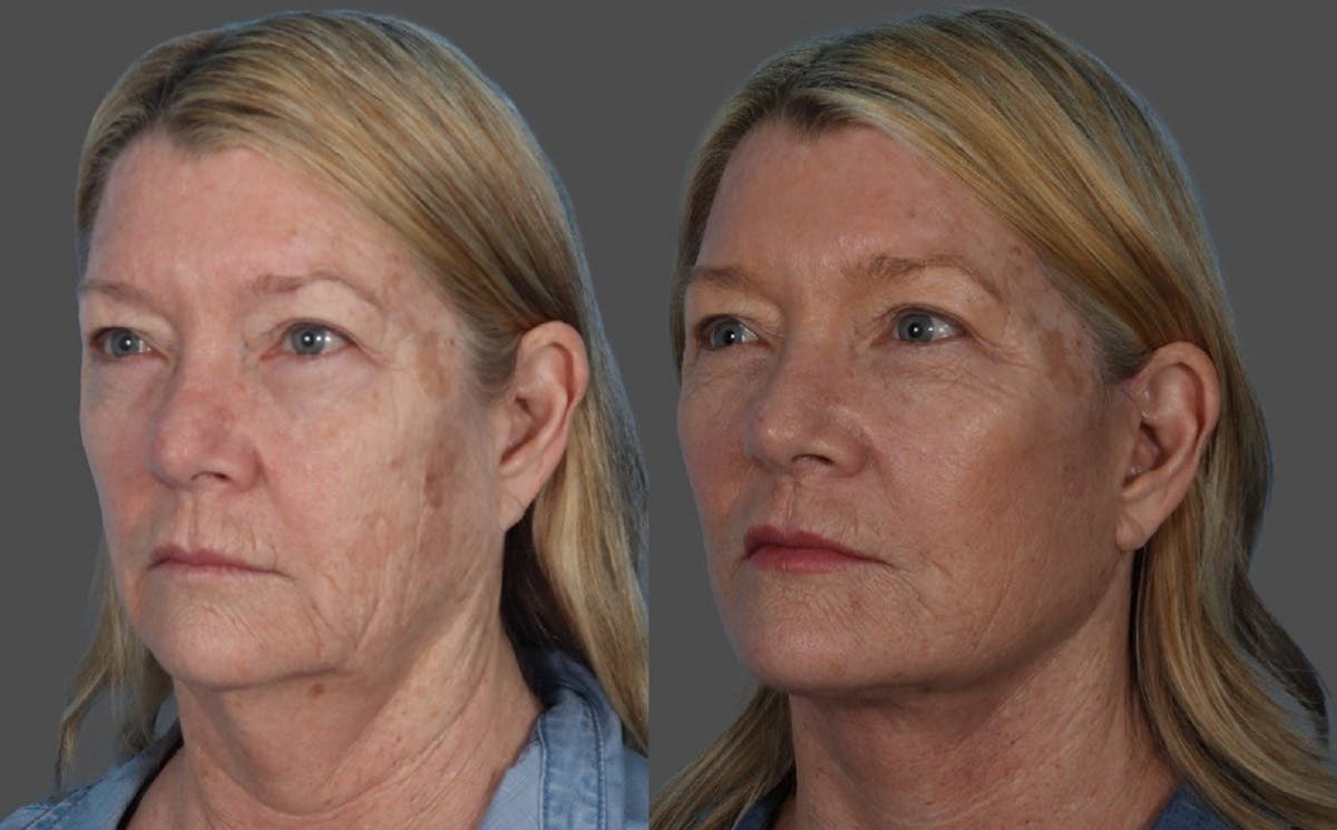 Facelift Before & After Gallery - Patient 855207 - Image 4