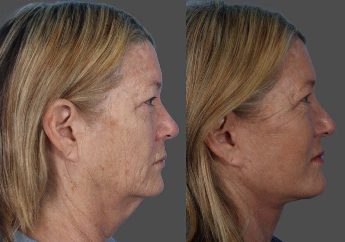 Facelift Before & After Gallery - Patient 855207 - Image 3