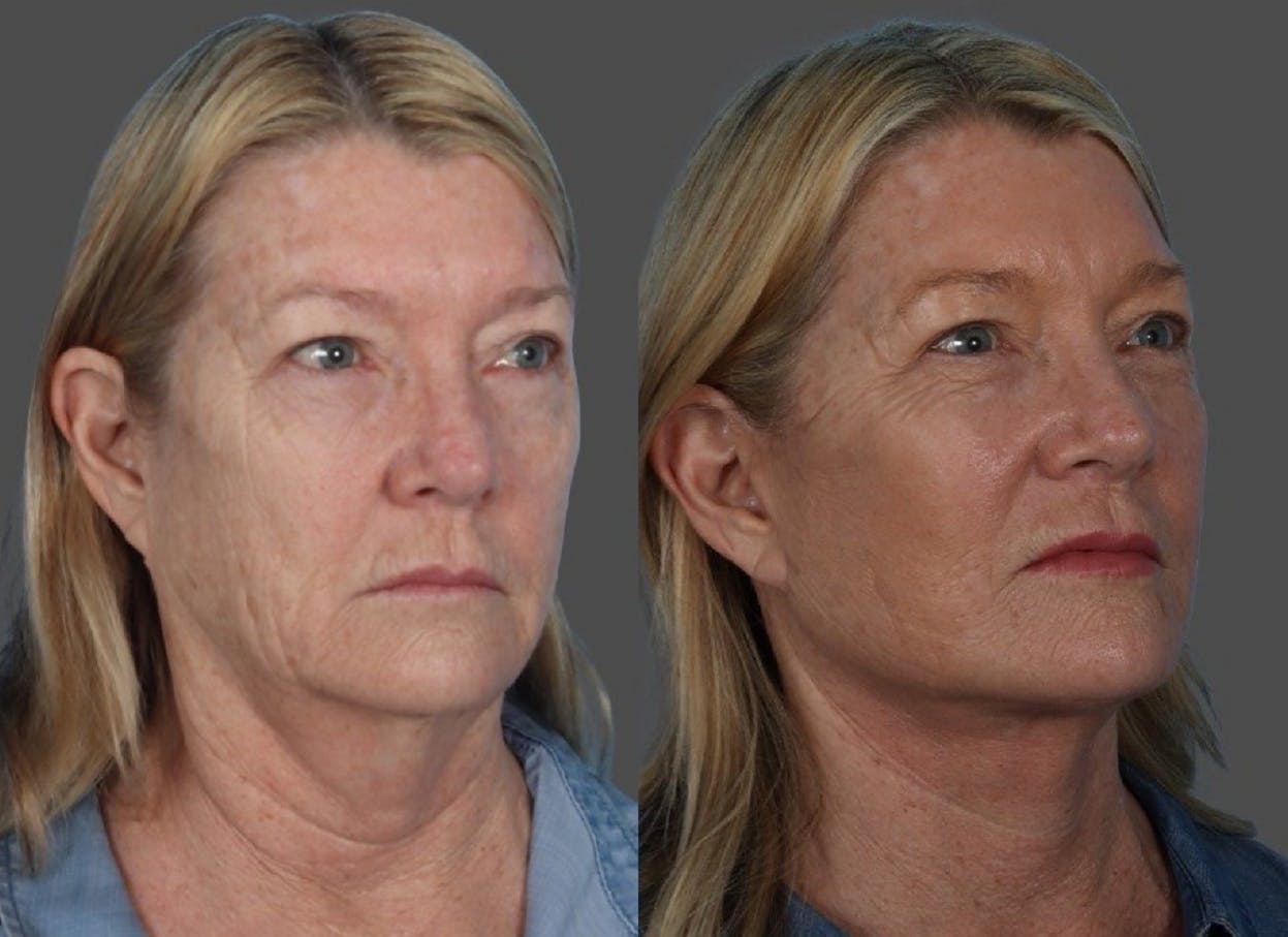 Facelift Before & After Gallery - Patient 855207 - Image 2