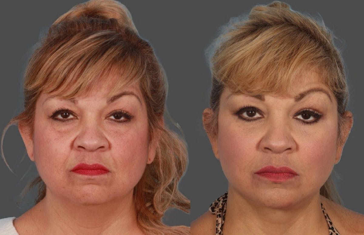 Facial Fat Transfer Before & After Gallery - Patient 231052 - Image 1