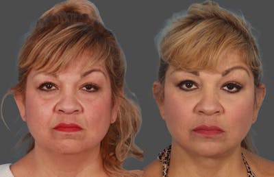 Eyelid Surgery (Blepharoplasty) Before & After Gallery - Patient 419462 - Image 1