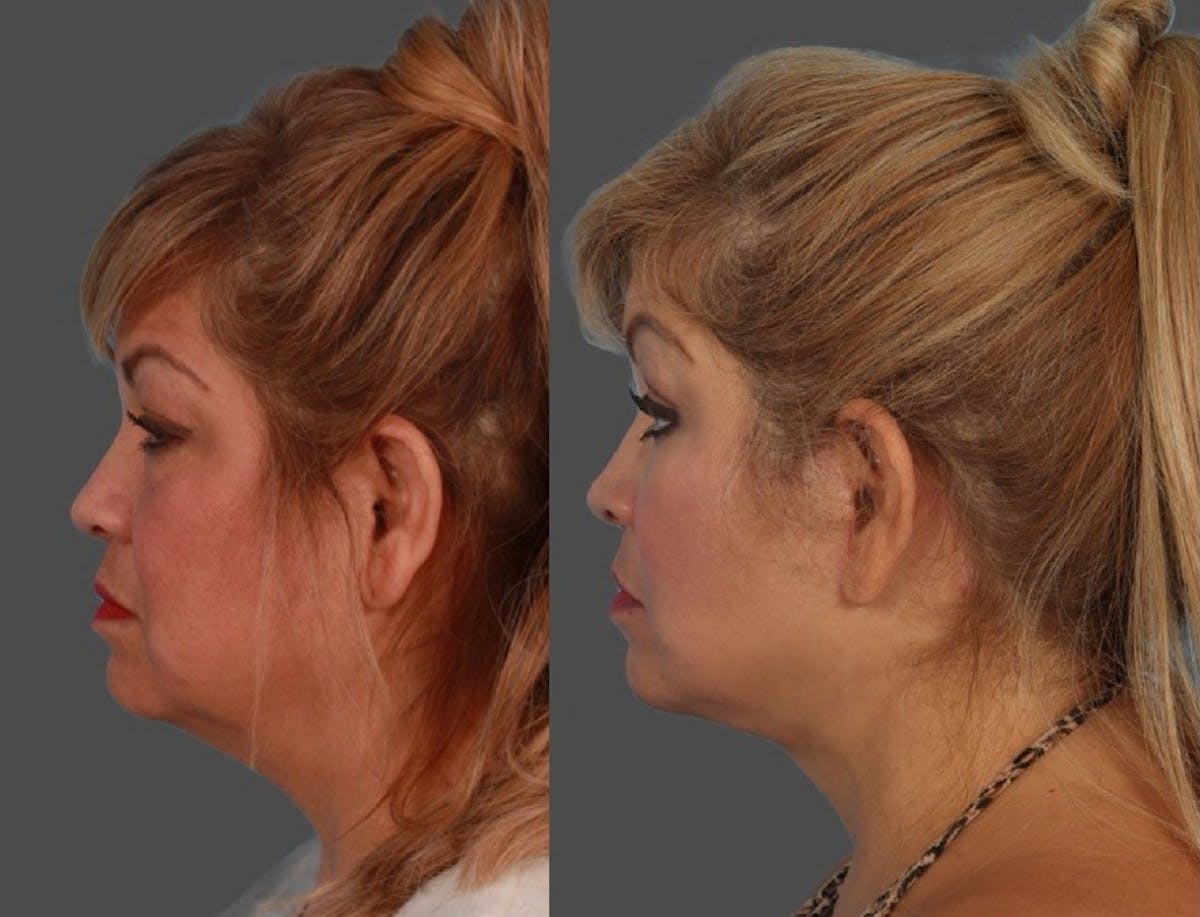 Facial Fat Transfer Before & After Gallery - Patient 231052 - Image 5