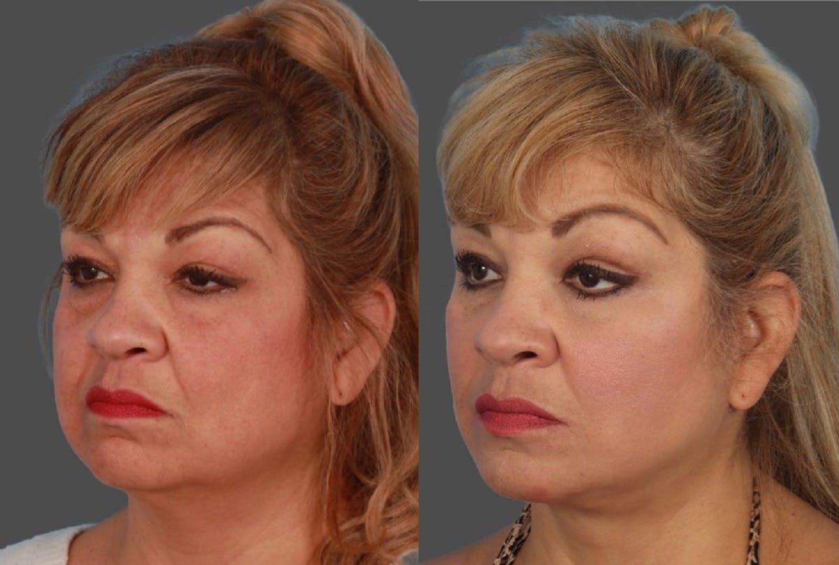Facial Fat Transfer Before & After Gallery - Patient 231052 - Image 4