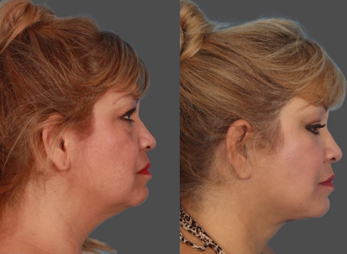 Facial Fat Transfer Before & After Gallery - Patient 231052 - Image 3