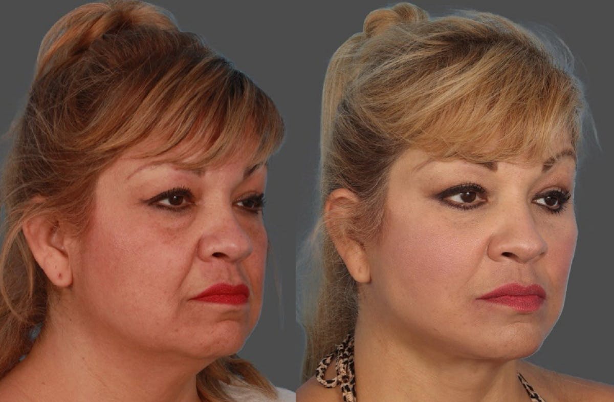 Facial Fat Transfer Before & After Gallery - Patient 231052 - Image 2