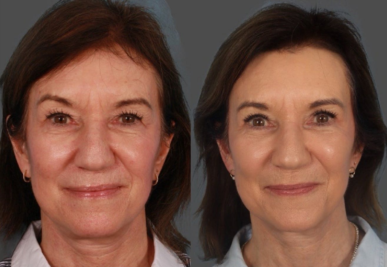 Facial Fat Transfer Before & After Gallery - Patient 951412 - Image 1