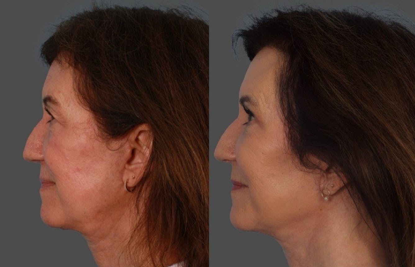 Facial Fat Transfer Before & After Gallery - Patient 951412 - Image 5