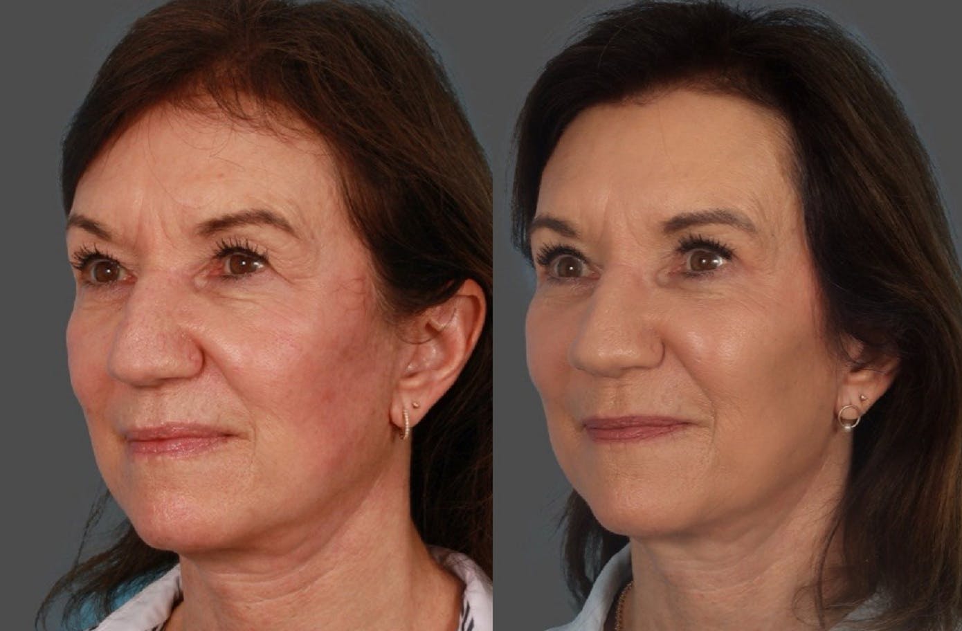 Facial Fat Transfer Before & After Gallery - Patient 951412 - Image 4