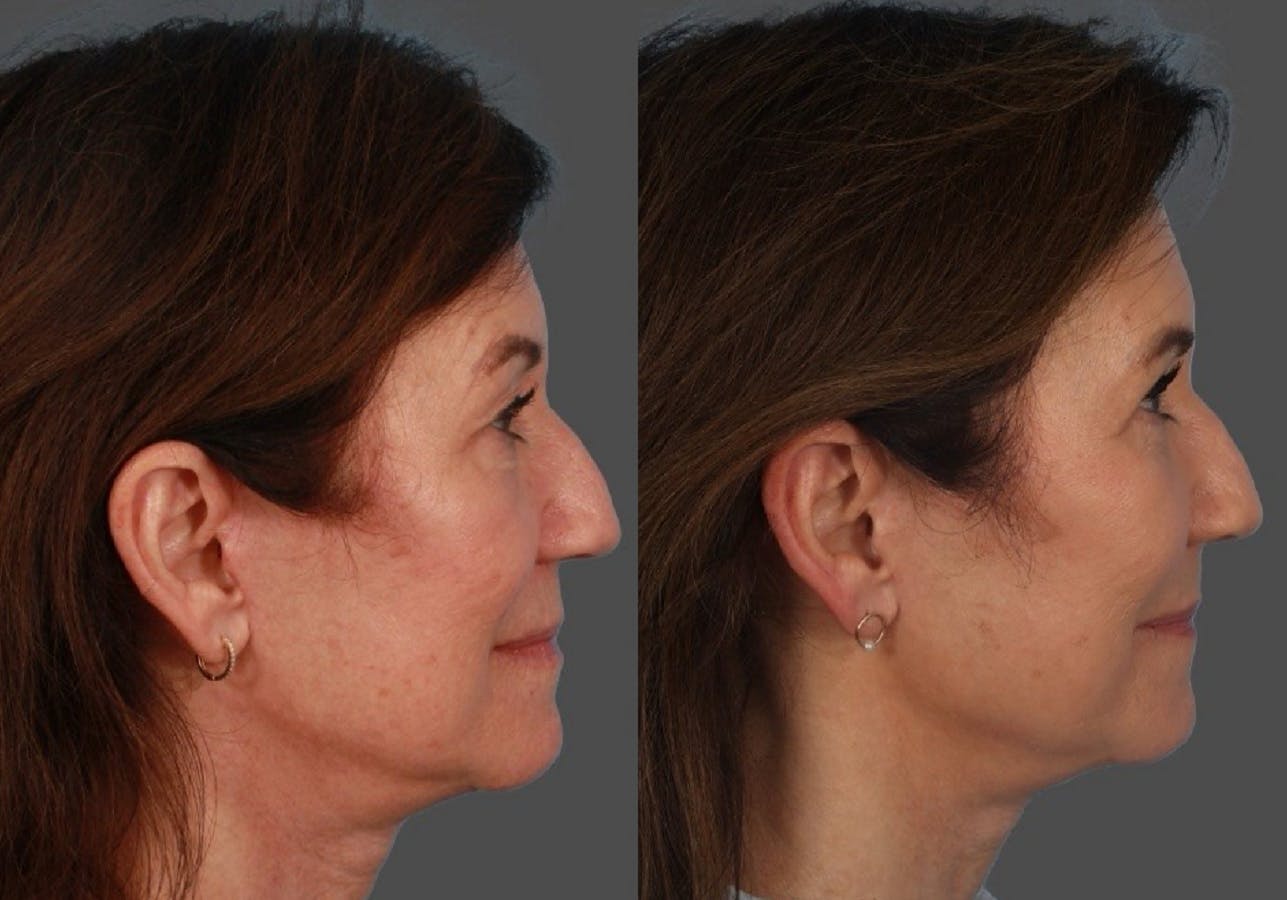 Facial Fat Transfer Before & After Gallery - Patient 951412 - Image 3