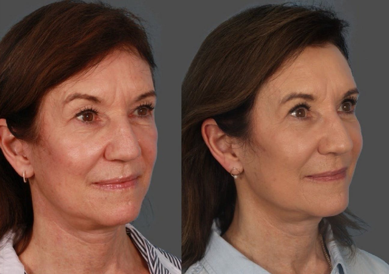Facial Fat Transfer Before & After Gallery - Patient 951412 - Image 2