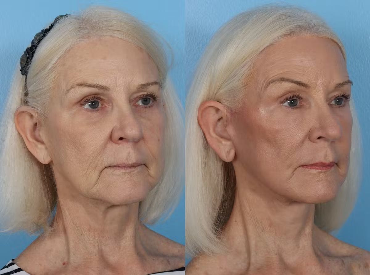 CO2 Fractional Laser Before & After Gallery - Patient 357015 - Image 2