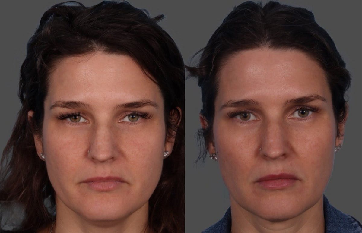 Sculptra Before & After Gallery - Patient 226300 - Image 1