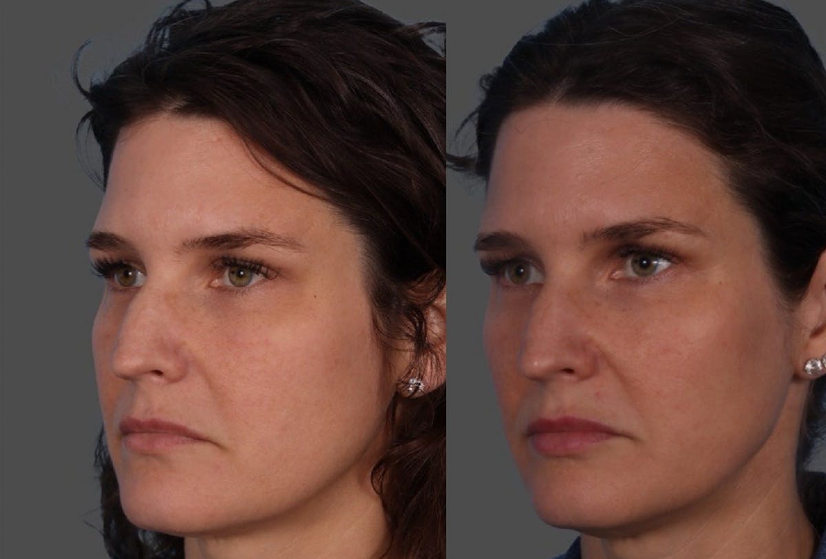 Sculptra Before & After Gallery - Patient 226300 - Image 3