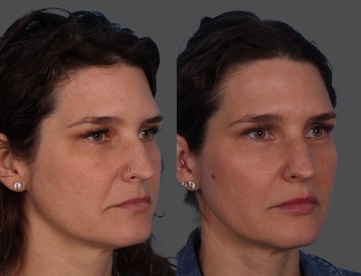 Restylane Before & After Gallery - Patient 124475 - Image 2
