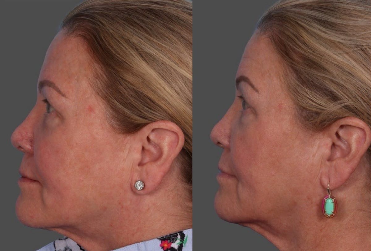 BBL (BroadBand Light)  Before & After Gallery - Patient 150182 - Image 5