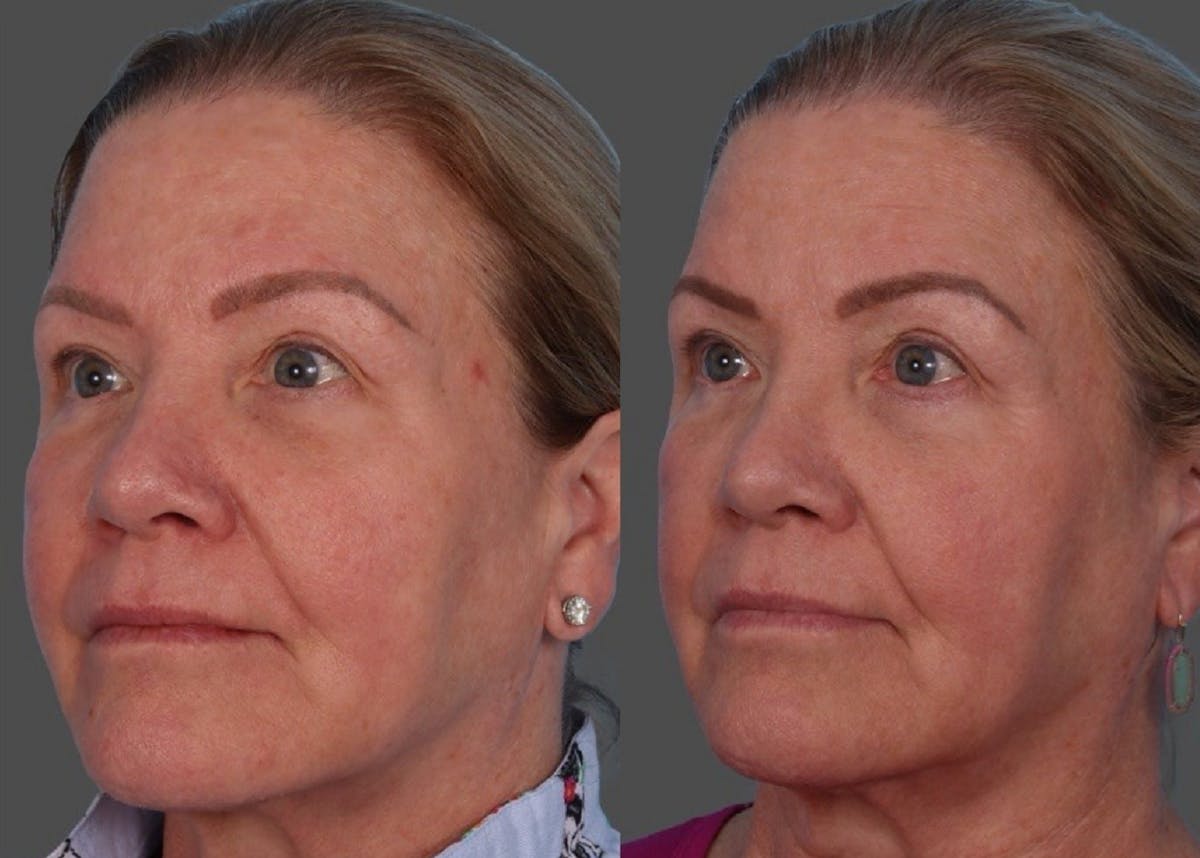 BBL (BroadBand Light)  Before & After Gallery - Patient 150182 - Image 4