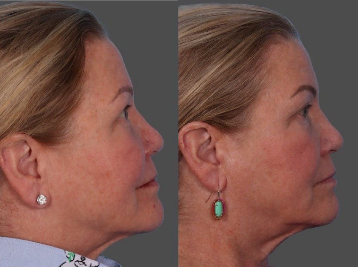 BBL (BroadBand Light)  Before & After Gallery - Patient 150182 - Image 3