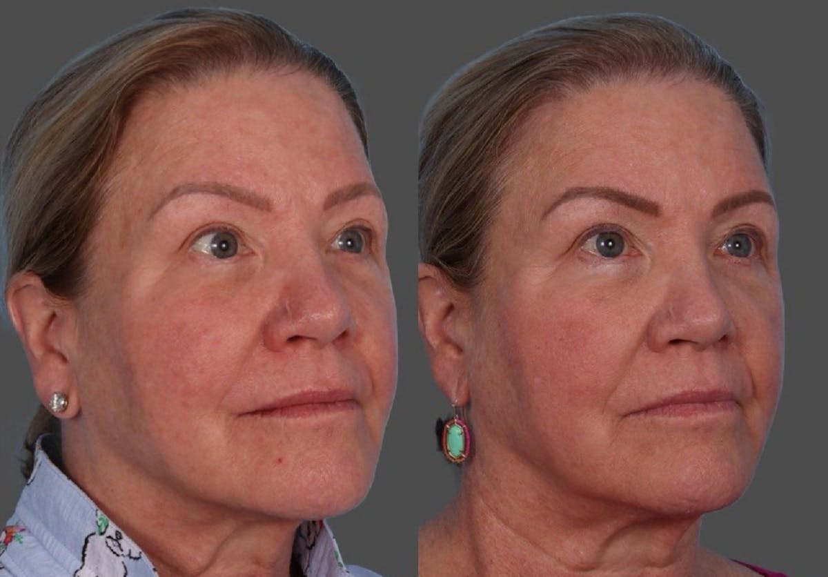 BBL (BroadBand Light)  Before & After Gallery - Patient 150182 - Image 2