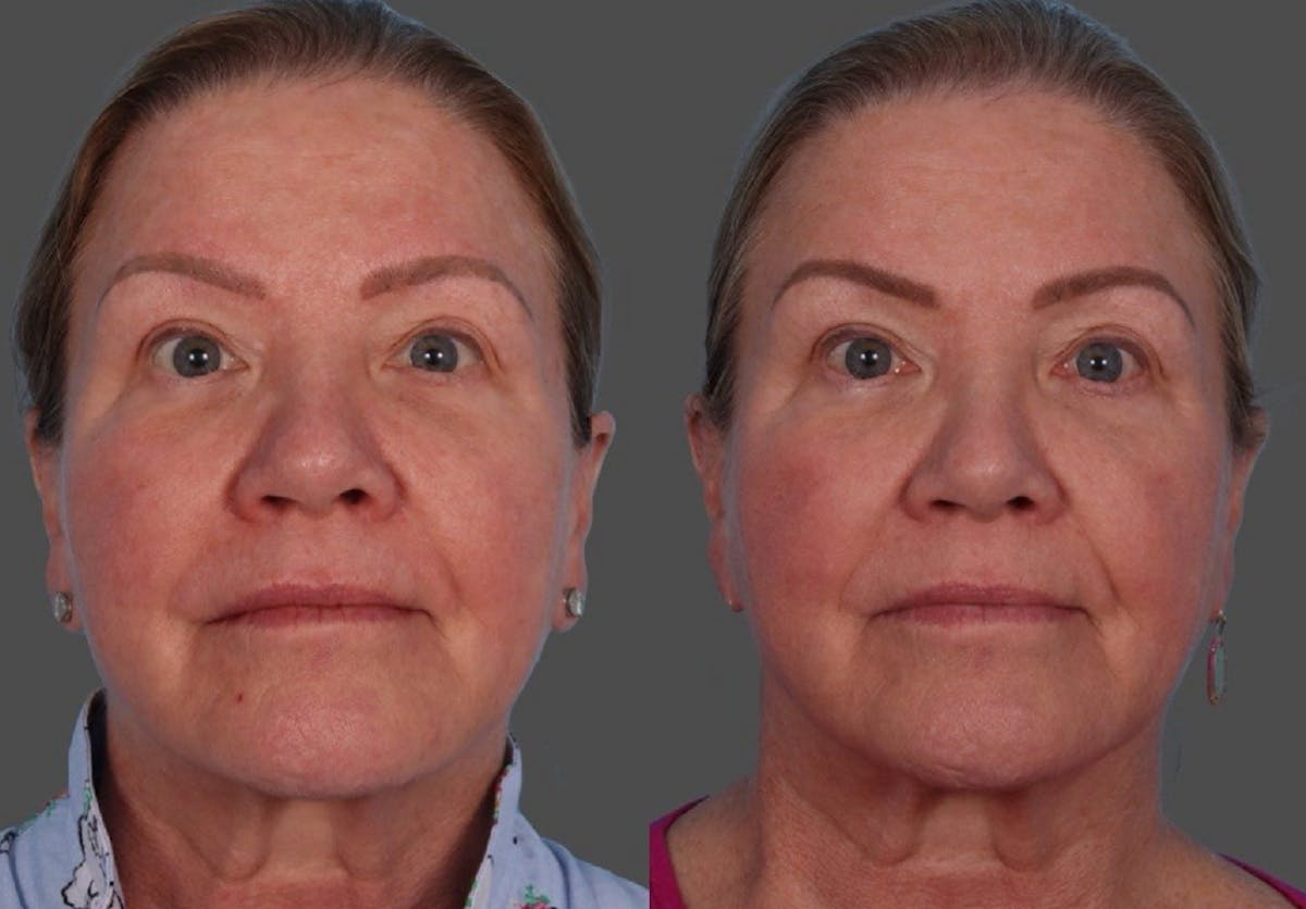 BBL (BroadBand Light)  Before & After Gallery - Patient 150182 - Image 1