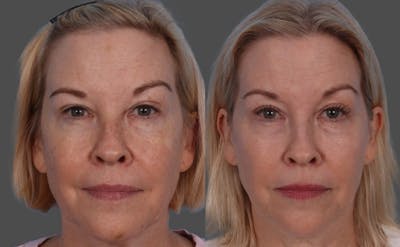 BBL (BroadBand Light)  Before & After Gallery - Patient 632702 - Image 1